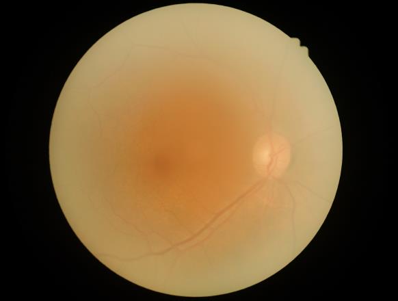 What is the prognosis for someone with macular pucker?